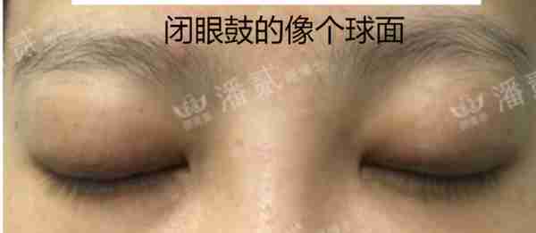 凸眼睛者:眼球突出、上睑凹陷或多层,双眼皮设计为何不宜过宽?