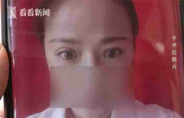 女子花9200换来“菜刀割的”双眼皮 机构:哪种手术是百分之百成功