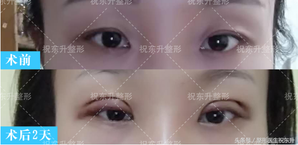 想做全切双眼皮,又担心不安全,有没有人可以给点真实性的建议?