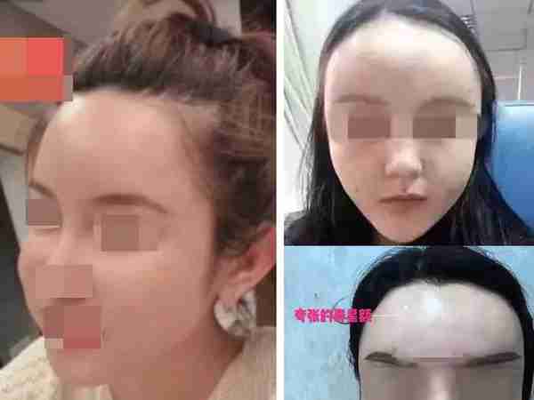 听说你想用玻尿酸填充?醒醒吧姑娘!汪教授愤怒揭秘这5个真相