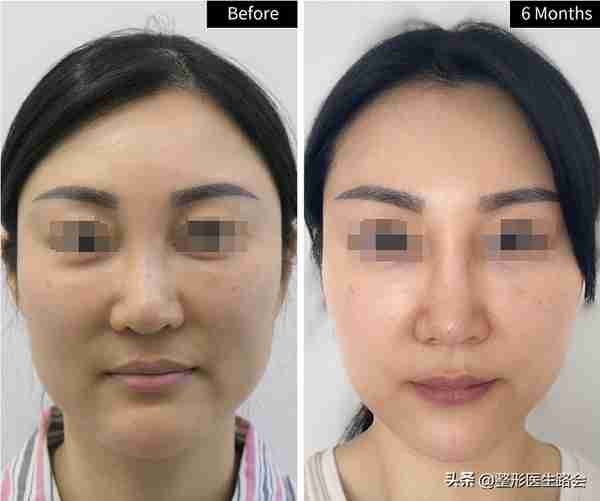 36岁女士隆鼻走弯路,膨体鼻修复+膨体填充鼻基底,6个月后大变样