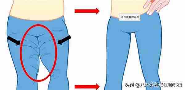 是不是任何一个肥胖部位都可以吸脂呢?