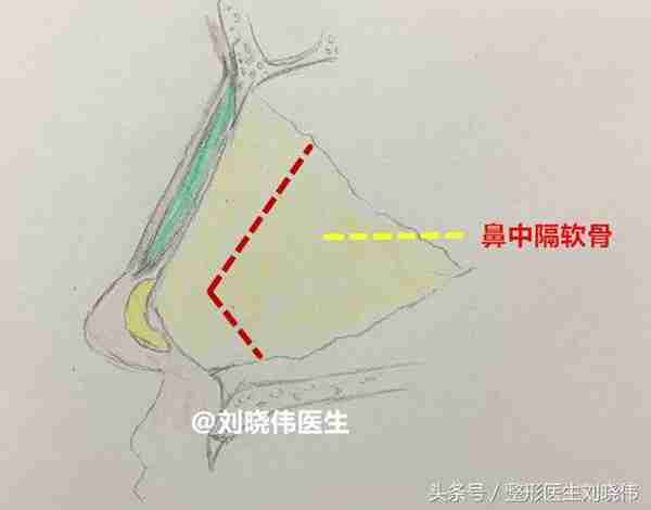 鼻整形科普：什么才是鼻综合手术？包含什么项目？