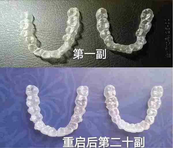 嘴突、乱牙,矫正两年之后我大变样!