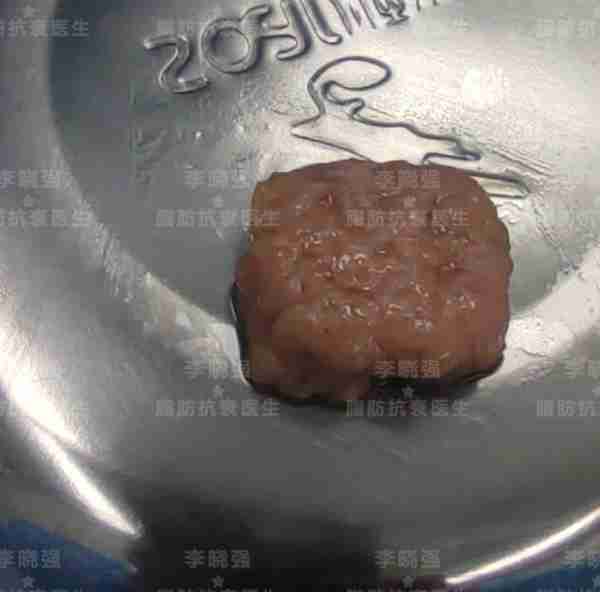 值得收藏!关于自体脂肪填充,那些整形医生不会告诉你的
