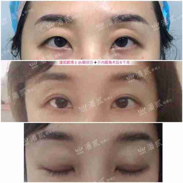 凸眼睛者:眼球突出、上睑凹陷或多层,双眼皮设计为何不宜过宽?