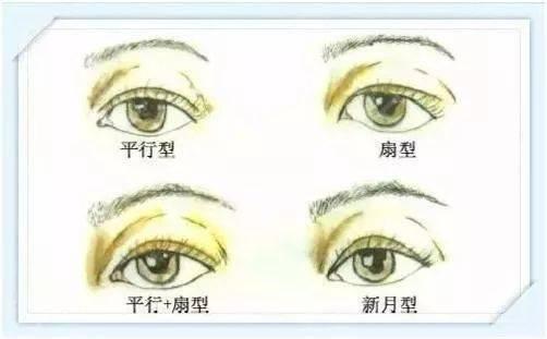 济南海峡整形分享：双眼皮这样做才好看