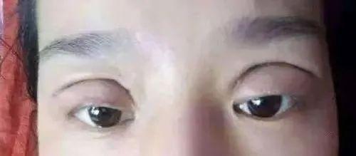 割双眼皮影响有多大?他们都是血淋淋的例子