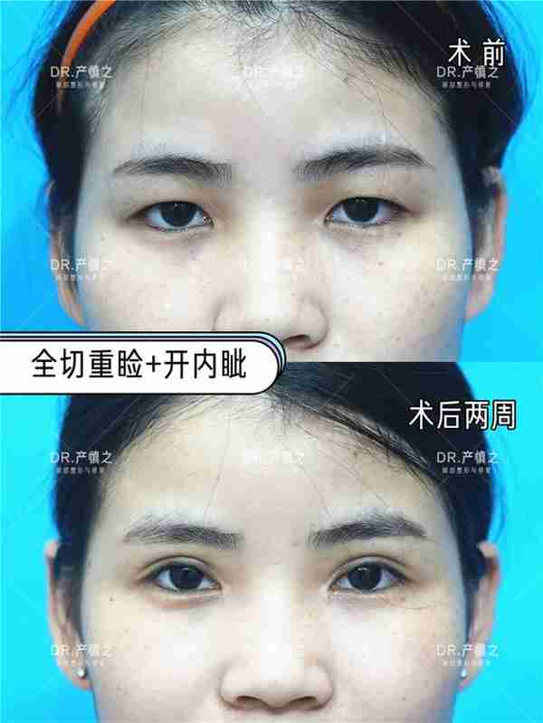 双眼皮是想做多宽就能做多宽吗?