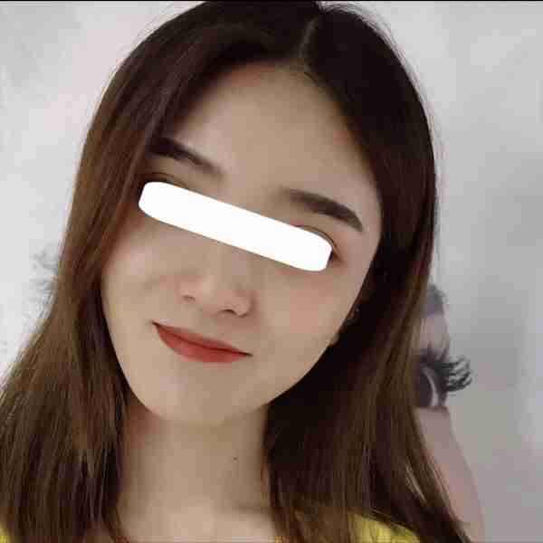 明星为什么喜欢“玻尿酸”填充全脸,而不是用自体脂肪填充呢?