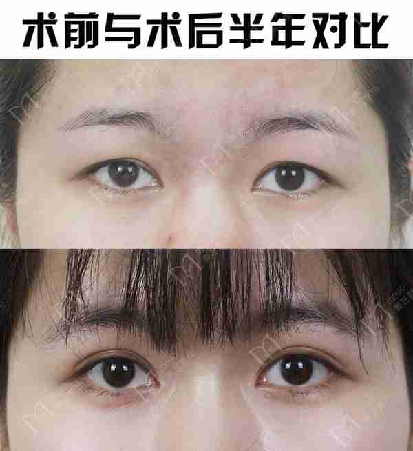 河南姑娘内双肿眼泡明显,我是如何给她设计自然款双眼皮的