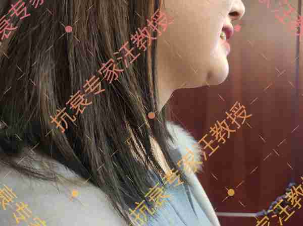 听说你想用玻尿酸填充?醒醒吧姑娘!汪教授愤怒揭秘这5个真相