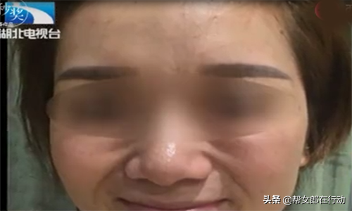 整容变毁容!女孩脸颊注射玻尿酸,近看面部凹凸不平一言难尽