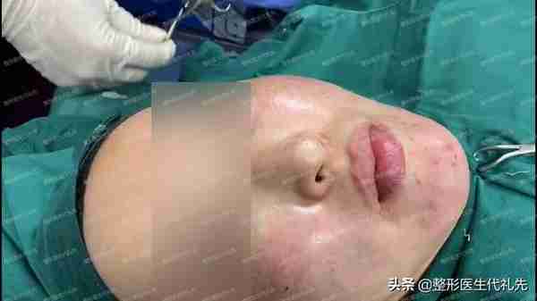 做脂肪填充之后,会下垂得更厉害?更容易显老?准备做面填来看看