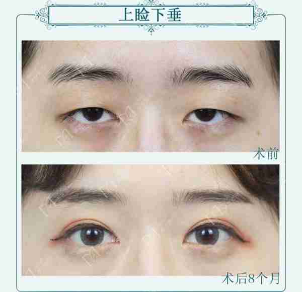 有人割双眼皮颜值大逆袭,而有人割了双眼皮后悔为何反差这样大呢