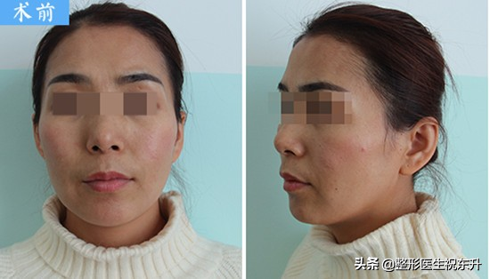 脂肪填充面部 | 别人看出来变美了,不知道哪里变了