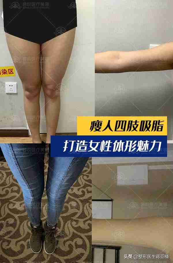 瘦人四肢吸脂,打造女性体形魅力