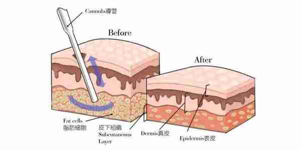 如何区分面部脂肪堆积与颊脂垫的问题?