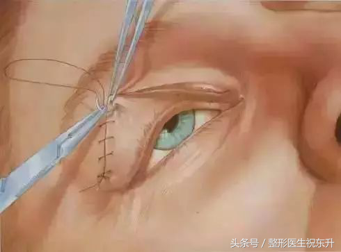 想做全切双眼皮,又担心不安全,有没有人可以给点真实性的建议?
