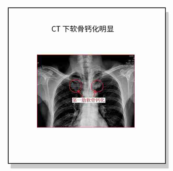 哪些求美者不能进行肋软骨隆鼻?