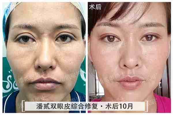 凸眼睛者:眼球突出、上睑凹陷或多层,双眼皮设计为何不宜过宽?