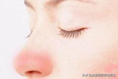 鼻整形术后严重疤痕增生该如何修复?