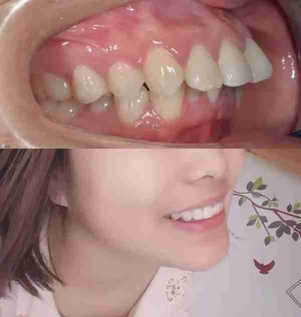 嘴突、乱牙,矫正两年之后我大变样!