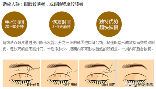 全切双眼皮不是说是永久的吗?为啥会消失呢?