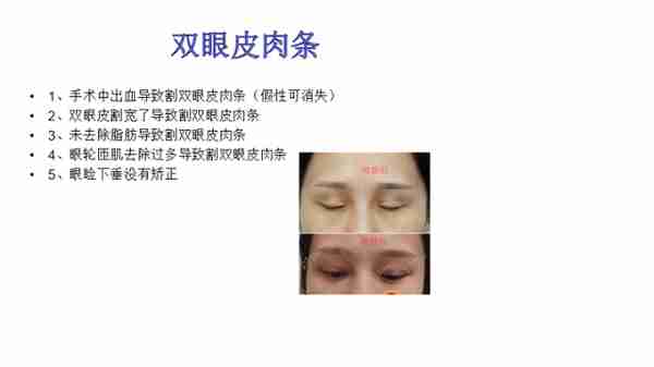双眼皮术后出现肉条不要急着做双眼皮修复,要先分析原因。