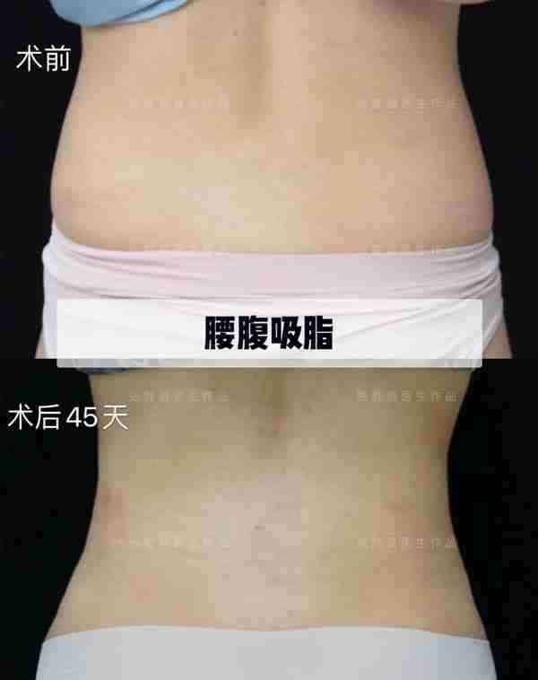 腰腹吸脂术后45天反馈
