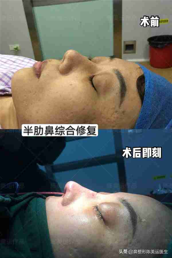 鼻整形术后严重疤痕增生该如何修复?