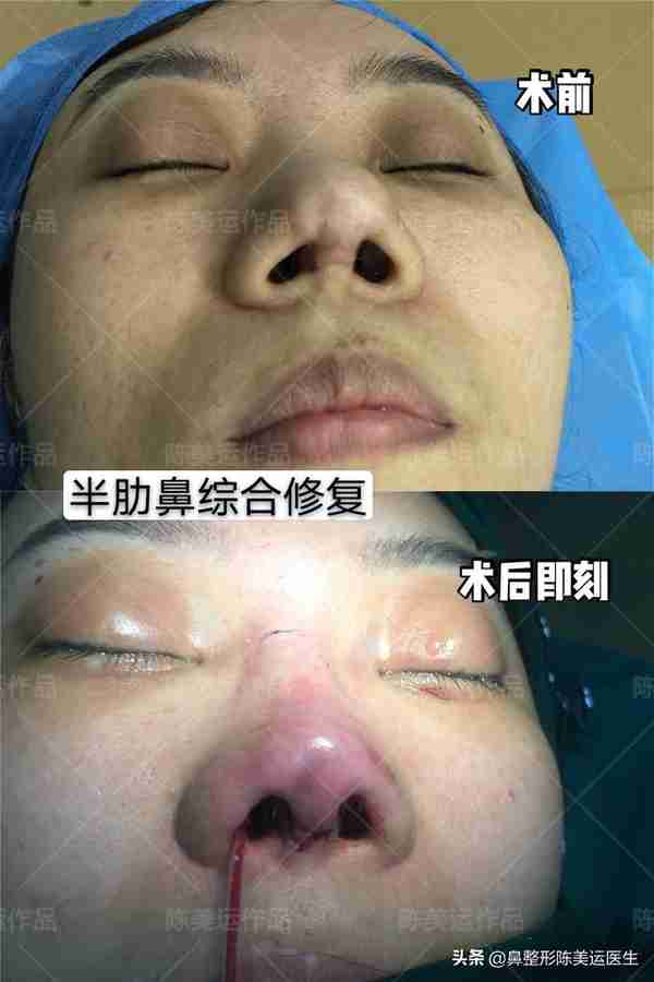 鼻整形术后严重疤痕增生该如何修复?