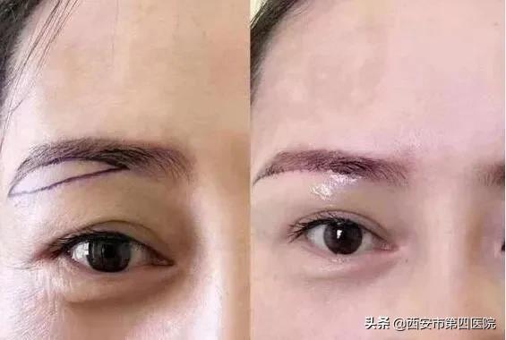 #安心变美课堂##我的安心变美推荐#眼皮松了,做提眉好还是双眼皮好