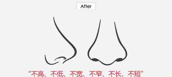 欧式挺隆鼻