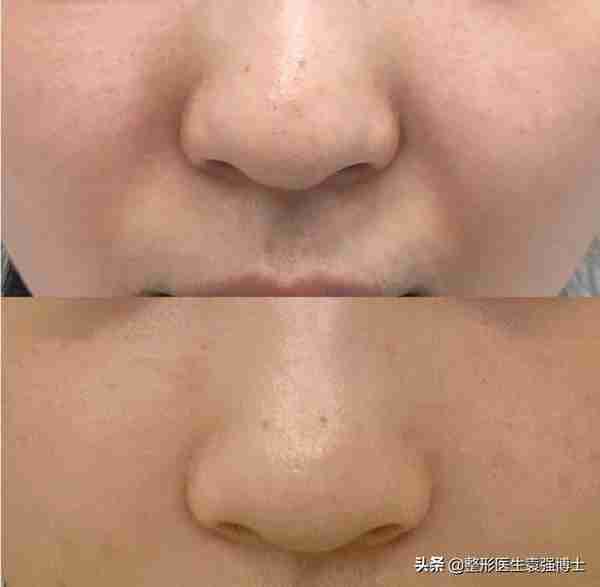 关于如何“消除”法令纹,整形医生有话说