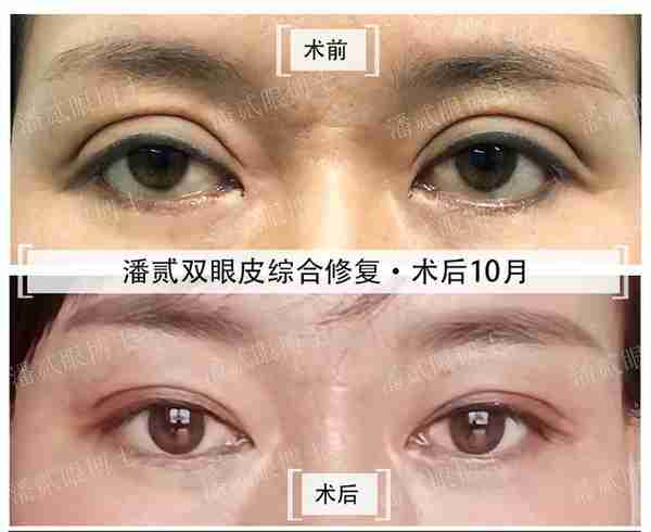 凸眼睛者:眼球突出、上睑凹陷或多层,双眼皮设计为何不宜过宽?