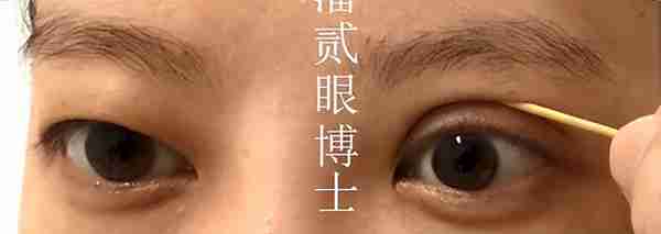 凸眼睛者:眼球突出、上睑凹陷或多层,双眼皮设计为何不宜过宽?