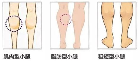 吸脂可以瘦腿吗?
