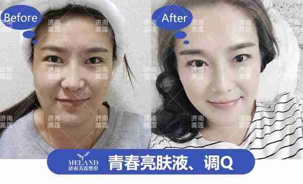 你知道你往脸上打的玻尿酸,是哪一类么?