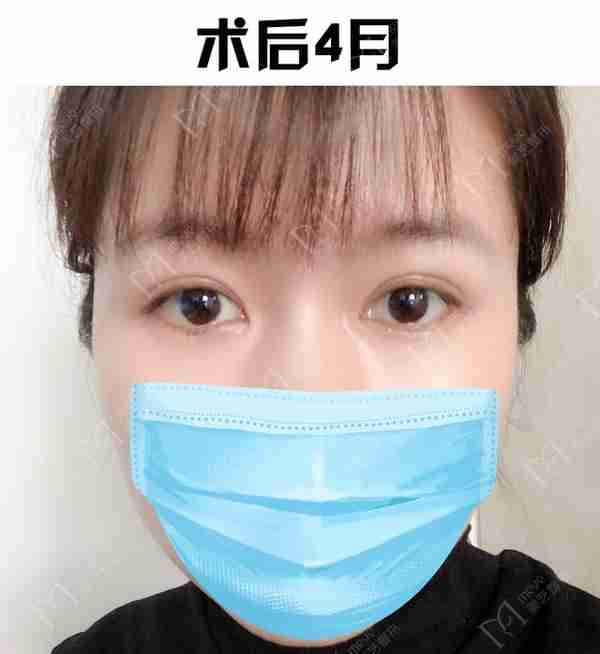 河南姑娘内双肿眼泡明显,我是如何给她设计自然款双眼皮的