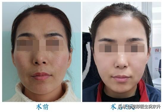 脂肪填充面部 | 别人看出来变美了,不知道哪里变了