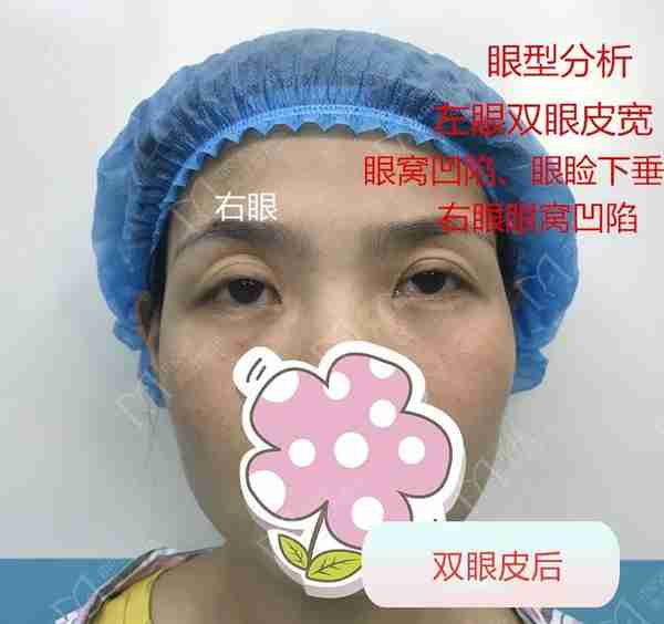 有人割双眼皮颜值大逆袭,而有人割了双眼皮后悔为何反差这样大呢