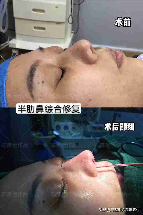 鼻整形术后严重疤痕增生该如何修复?