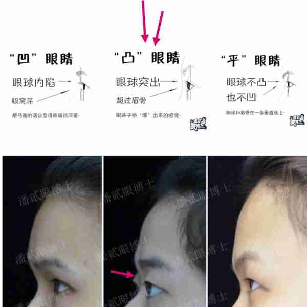 凸眼睛者:眼球突出、上睑凹陷或多层,双眼皮设计为何不宜过宽?