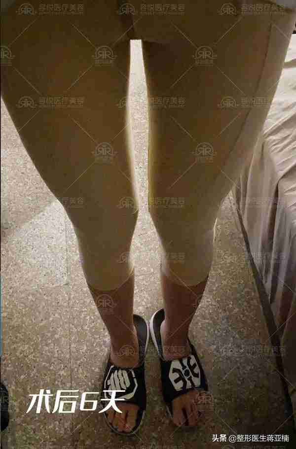 瘦人四肢吸脂,打造女性体形魅力