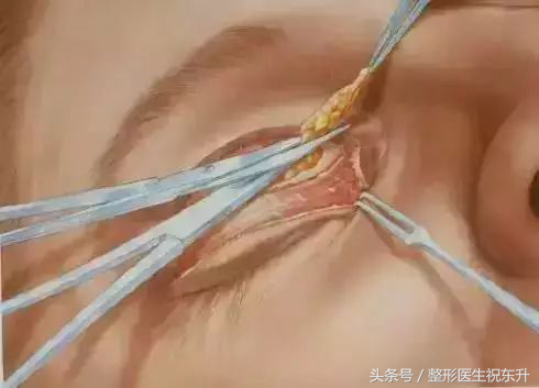 想做全切双眼皮,又担心不安全,有没有人可以给点真实性的建议?