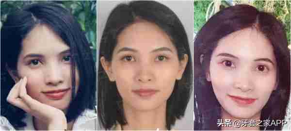 正畸分享|骨性前突、重度深覆合深覆盖、牙列不齐、严重露龈笑