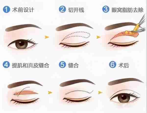 双眼皮手术类型常见的有三种,看完这篇文章,你就知道该怎么选了