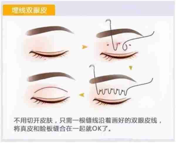 双眼皮手术类型常见的有三种,看完这篇文章,你就知道该怎么选了