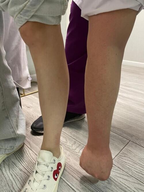 80多斤女孩要吸脂瘦腿被医生劝退:我的前臂都比你小腿粗